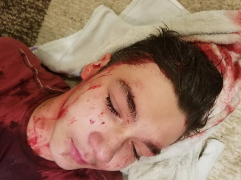 У с. Гора чоловік пляшкою розбив голову своєму сину У с. Гора чоловік пляшкою розбив голову своєму сину