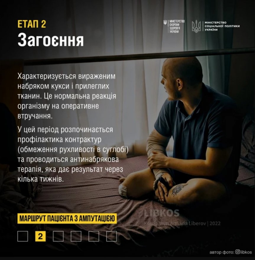 Допомога при ампутації: у МОЗ розповіли про етапи лікування та реабілітації Допомога при ампутації: у МОЗ розповіли про етапи лікування та реабілітації