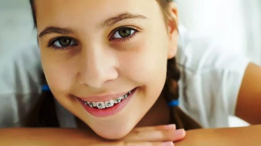 Вирівнювання зубів у дітей: коли варто починати шлях до красивої посмішки Вирівнювання зубів у дітей: коли варто починати шлях до красивої посмішки
